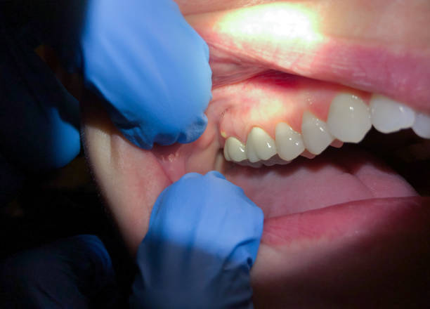 Best Cracked Tooth Emergency Dentist  in Highland Beach, FL